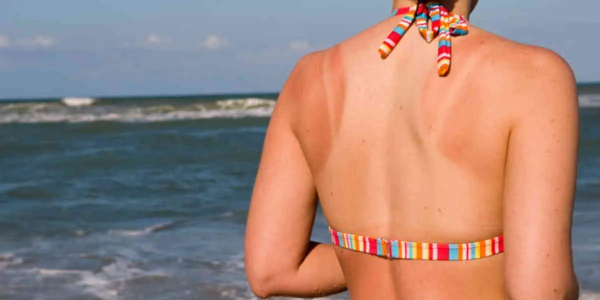 burn-lines-ou-tan-lines - Votre Actualité au Quotidien Ces nouvelles tendances de bronzage, dangereuses pour la santé