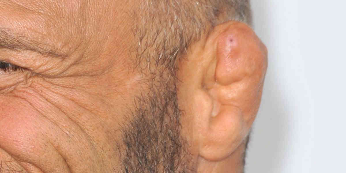 La mode des oreilles en